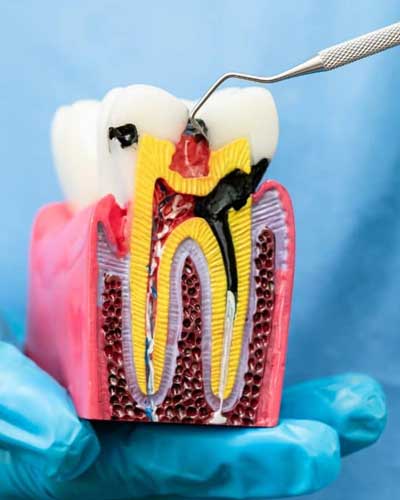 Root Canal