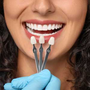 Veneers