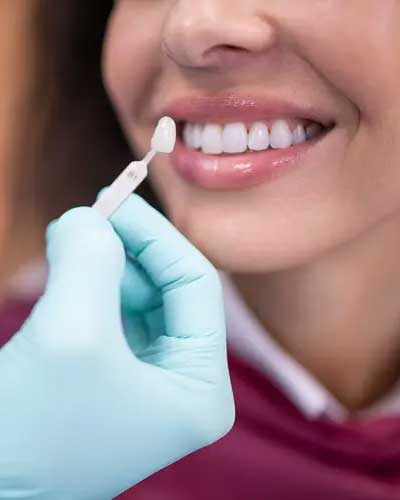 Veneers
