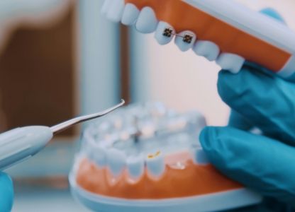 Understanding the Connection Between Lupus and Oral Health