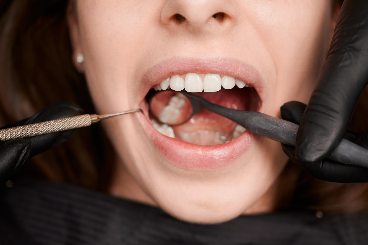What Is a Gingivoplasty and When Is It Necessary