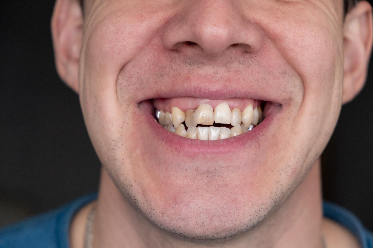 How to Correct Crowded Teeth: Causes and Best Treatments