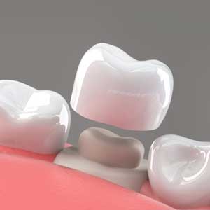 Dental Crowns and Caps