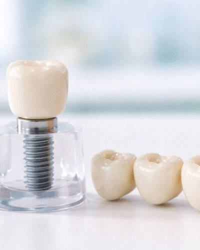 Bridges & Dental Implants