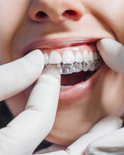 Invisalign