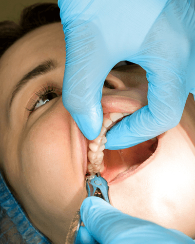 Root Canal