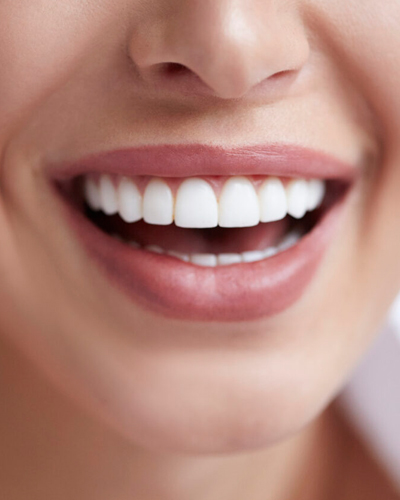 Veneers