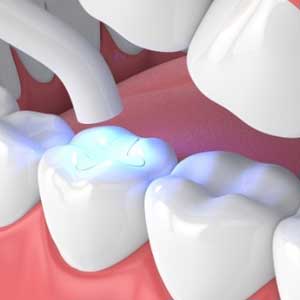 Amalgam Free Fillings