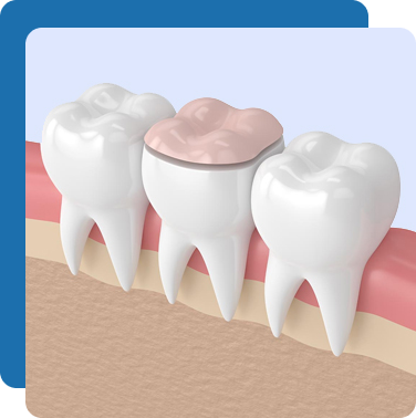 Porcelain Inlays & Onlays
