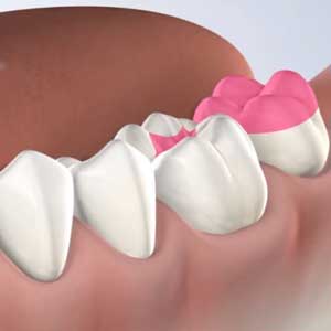 Porcelain Inlays & Onlays