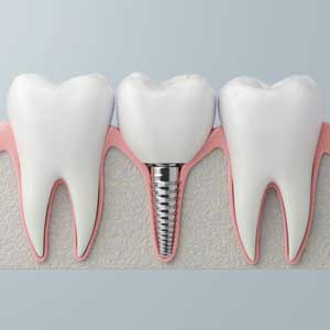 Bridges & Implants