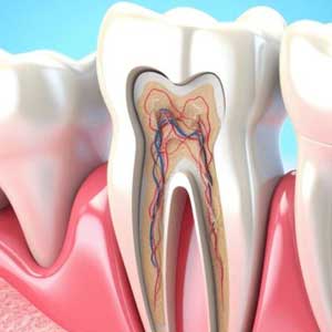 Root Canals