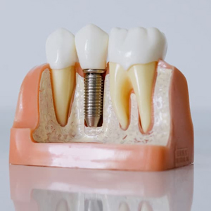 Bridges & Dental Implants