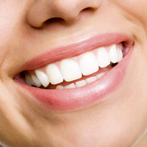 Teeth Whitening