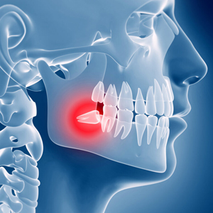 Wisdom Teeth Extraction