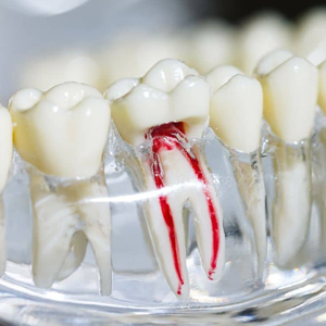 Root Canal