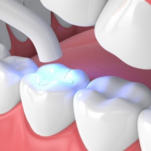 Amalgam Free Fillings