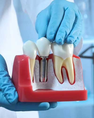 Bridges & Implants
